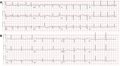 Case report: A case of hypocalcemic cardiomyopathy with non-reversible cardiac fibrosis